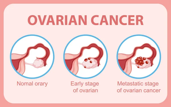 Ilustración Infográfica Del Cáncer Ovario — Vector de stock