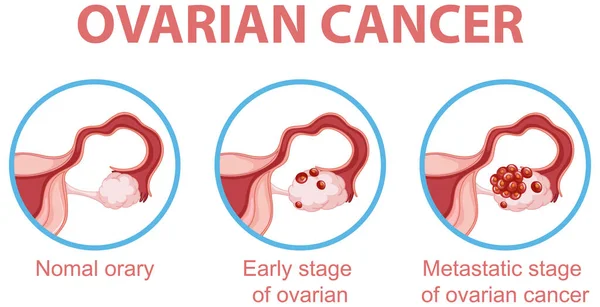Proceso Desarrollo Del Cáncer Ovario Ilustración Infográfica — Vector de stock