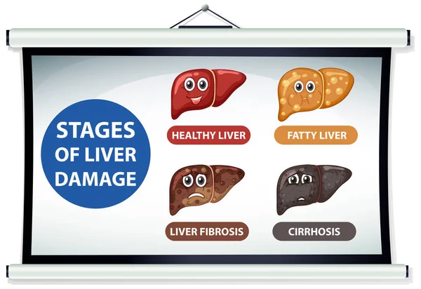 Diagram Som Visar Stadier Leverskada Illustration — Stock vektor