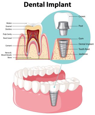 Diş implantı illüstrasyonunda insan yapısı hakkında bilgi