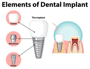 Diş implantı illüstrasyonunda insan yapısı hakkında bilgi