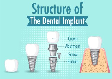 Diş implantı illüstrasyonunda insan yapısı hakkında bilgi