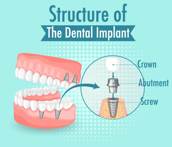 Infografía Del Humano Estructura Ilustración Del Implante Dental — Archivo Imágenes Vectoriales
