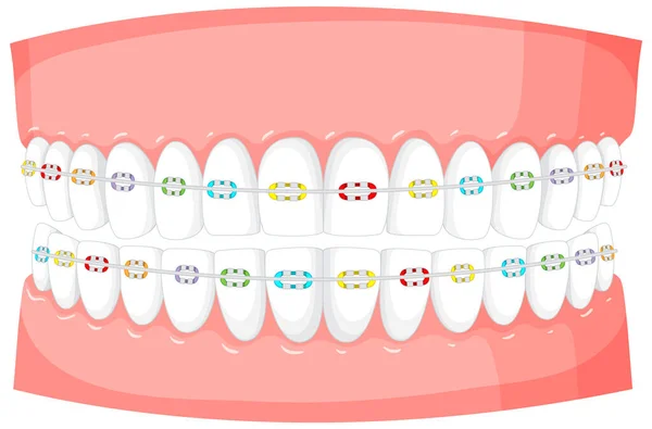 Aparelhos Modelo Dentes Humanos Fundo Branco Ilustração —  Vetores de Stock