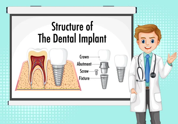 Emberi Fogászati Implantátum Illusztráció Infografikája — Stock Vector