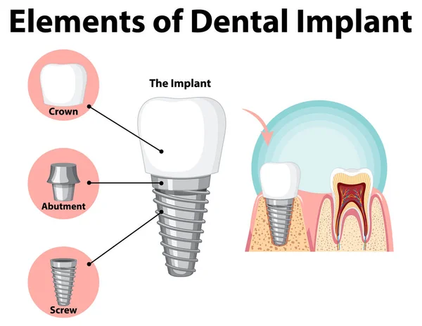 Infografía Del Humano Estructura Ilustración Del Implante Dental — Archivo Imágenes Vectoriales