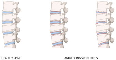 Infographic of healthy spine and ankylosing spondylitis illustration clipart
