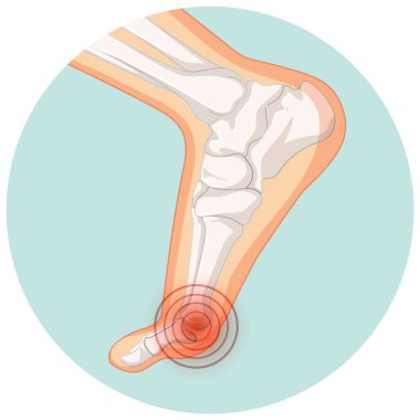 Hallux valgus tipleri daire şablon illüstrasyonunda