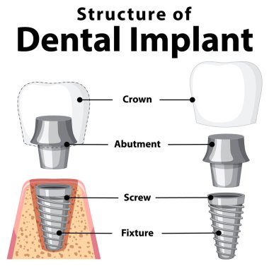 Diş implantı illüstrasyonunda insan yapısı hakkında bilgi