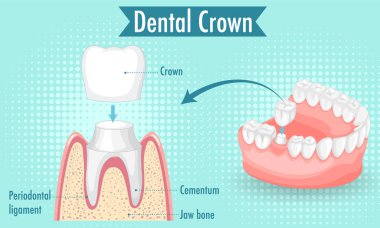 Infographic of human in dental crown illustration clipart