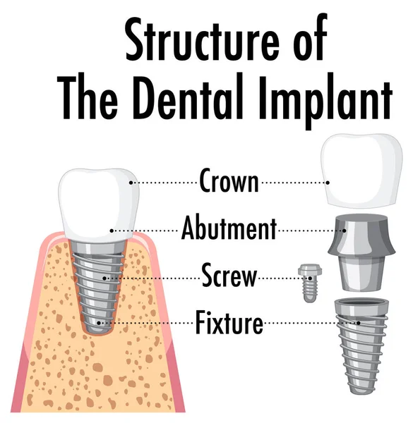 Infografía Del Humano Estructura Ilustración Del Implante Dental — Archivo Imágenes Vectoriales