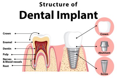 Diş implantı illüstrasyonunda insan yapısı hakkında bilgi