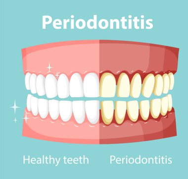 Periodontit illüstrasyonunda insan bilgisi