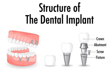 Diş implantı illüstrasyonunda insan yapısı hakkında bilgi