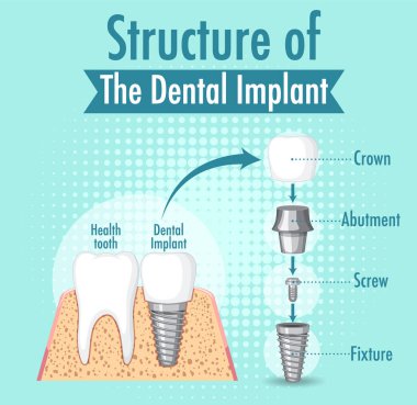 Diş implantı illüstrasyonunda insan yapısı hakkında bilgi