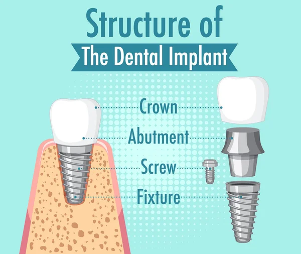 Infografía Del Humano Estructura Ilustración Del Implante Dental — Archivo Imágenes Vectoriales