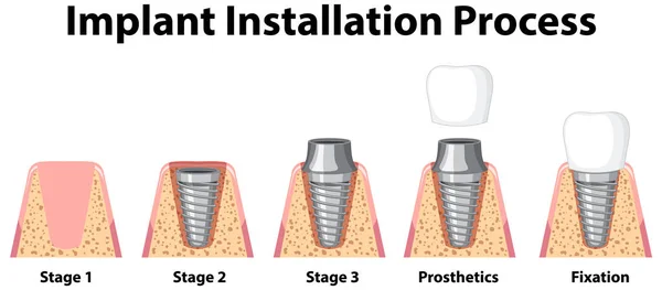 Infografía Del Humano Instalación Implantes Ilustración Del Proceso — Vector de stock