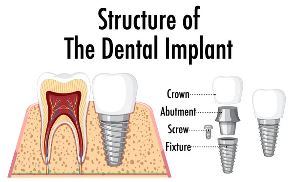 Infografía Del Humano Estructura Ilustración Del Implante Dental — Archivo Imágenes Vectoriales