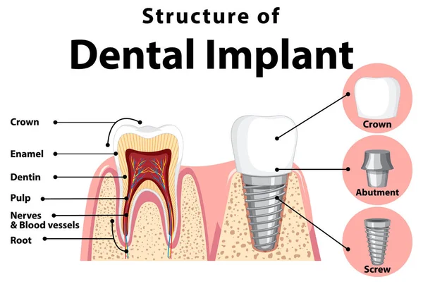 Infografik Des Menschen Der Struktur Des Zahnimplantats Illustration — Stockvektor