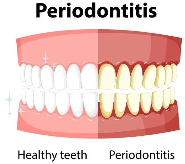 牙周炎病例中的人体信息图 — 图库矢量图片