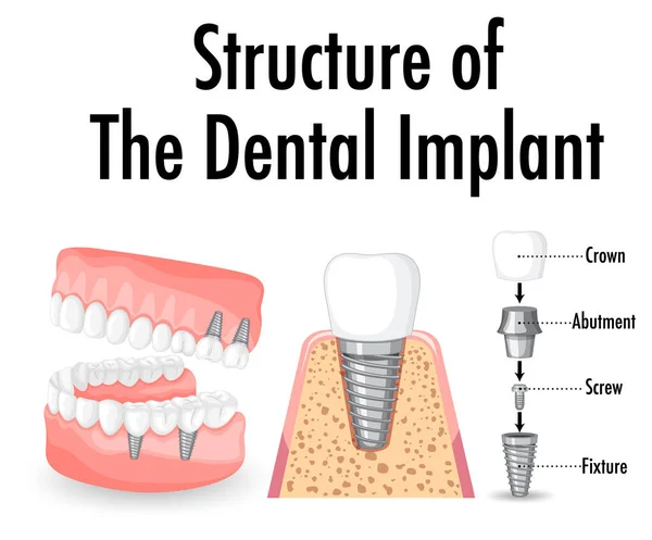 Infografía Del Humano Estructura Ilustración Del Implante Dental — Archivo Imágenes Vectoriales