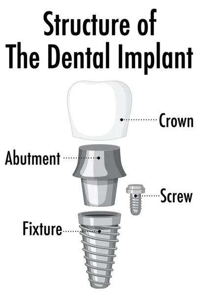 Estructura Del Implante Dental Sobre Fondo Blanco Ilustración — Vector de stock