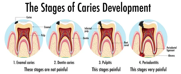 Инфографика Человека Этапах Развития Кариеса — стоковый вектор