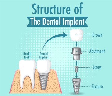 Diş implantı illüstrasyonunda insan yapısı hakkında bilgi