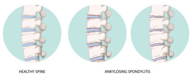 Infographic of healthy spine and ankylosing spondylitis illustration clipart