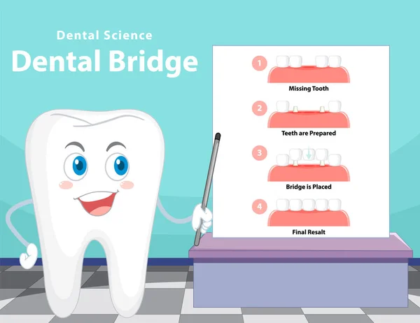 Illustrazione Infografica Ponti Dentali — Vettoriale Stock