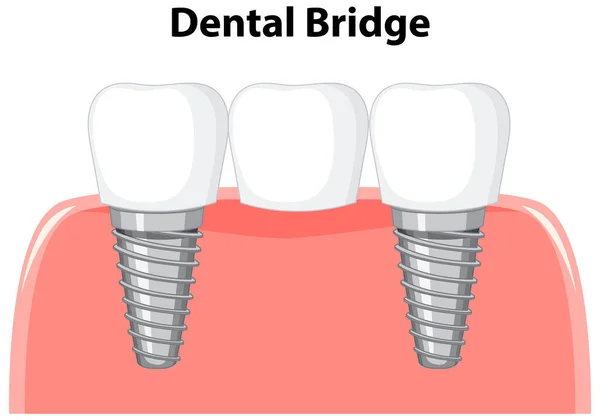 Dental bridge in gum on white background illustration