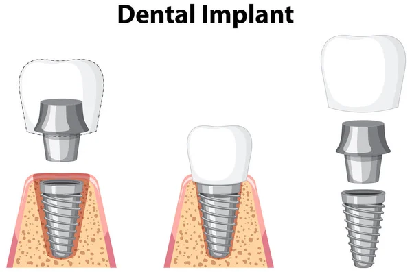 Implante Dental Encía Sobre Fondo Blanco Ilustración — Archivo Imágenes Vectoriales