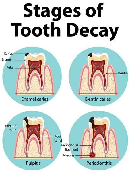 Infografía Del Ser Humano Las Etapas Caries Dental Ilustración — Vector de stock