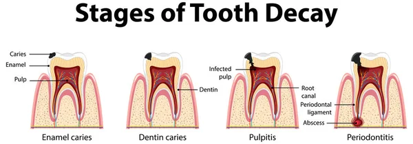 Infografía Del Ser Humano Las Etapas Caries Dental Ilustración — Vector de stock