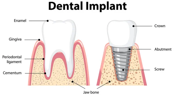 Infografik Des Menschen Der Struktur Des Zahnimplantats Illustration — Stockvektor