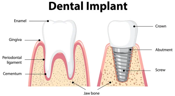 Emberi Fogászati Implantátum Illusztráció Infografikája — Stock Vector