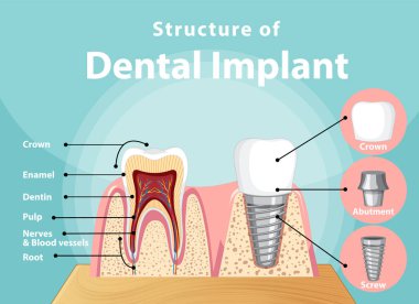 Diş implantı illüstrasyonunda insan yapısı hakkında bilgi