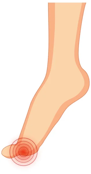 Hallux Valgus Typer Vit Bakgrund Illustration — Stock vektor