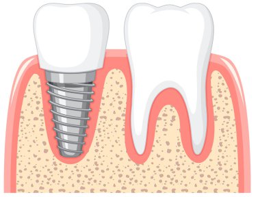 Sağlıklı diş ve diş implantı beyaz arkaplan illüstrasyonunda sakıza.