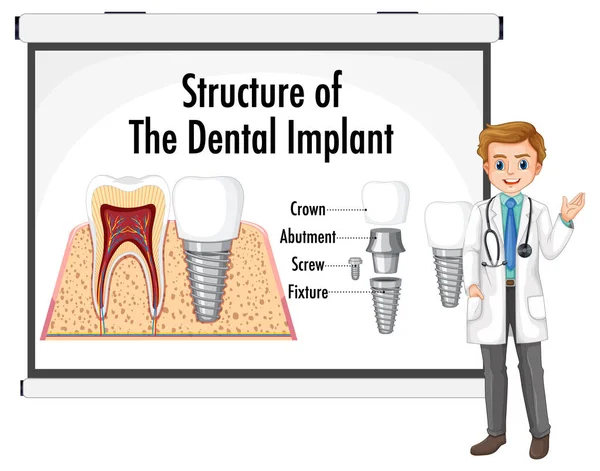 Emberi Fogászati Implantátum Illusztráció Infografikája — Stock Vector