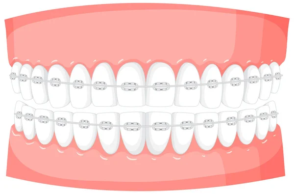 Aparelhos Modelo Ilustração Dentes Humanos —  Vetores de Stock