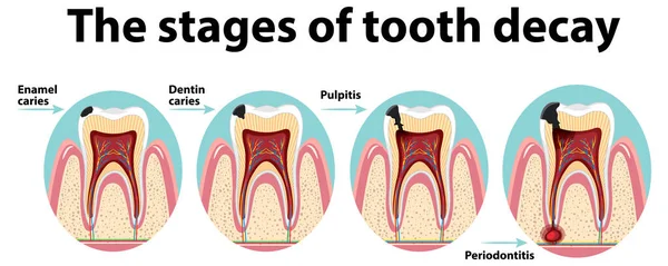 Infografía Del Ser Humano Las Etapas Caries Dental Ilustración — Vector de stock
