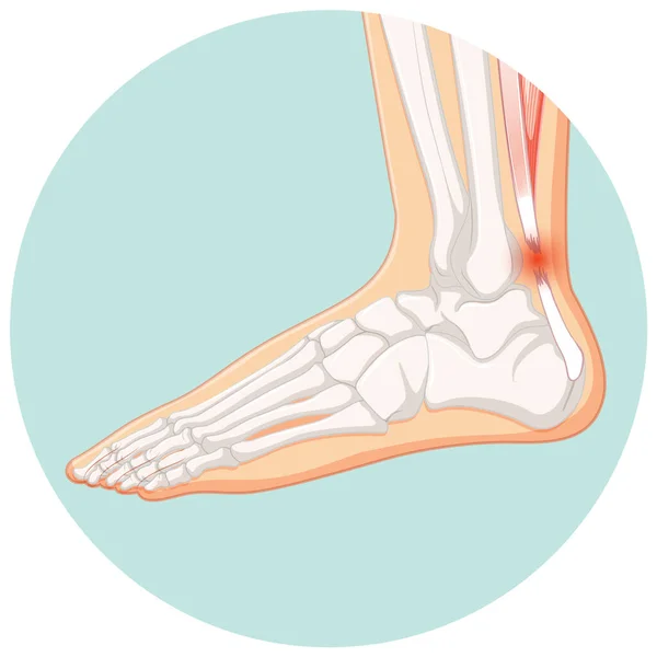 Rompimento Aquiles Tendo Modelo Círculo Ilustração Vetores De Bancos De Imagens