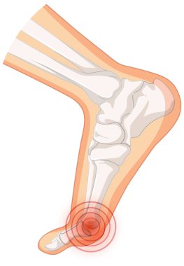 Beyaz arkaplan illüstrasyonunda Hallux valgus tipleri