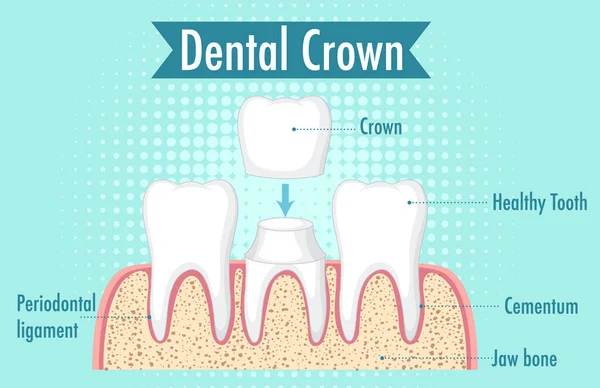 Infografía Del Ser Humano Ilustración Corona Dental — Vector de stock