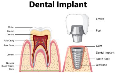 Diş implantı illüstrasyonunda insan yapısı hakkında bilgi
