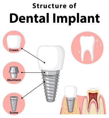 Diş implantı illüstrasyonunda insan yapısı hakkında bilgi
