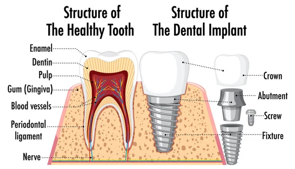 Infografica Della Struttura Umana Del Dente Sano Illustrazione — Vettoriale Stock