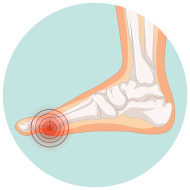 Hallux valgus tipleri daire şablon illüstrasyonunda