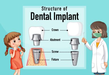 Diş implantı illüstrasyonunda insan yapısı hakkında bilgi